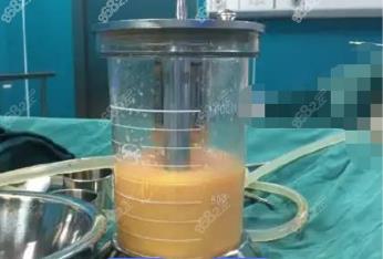 海东360度水动力吸脂费用多少钱？